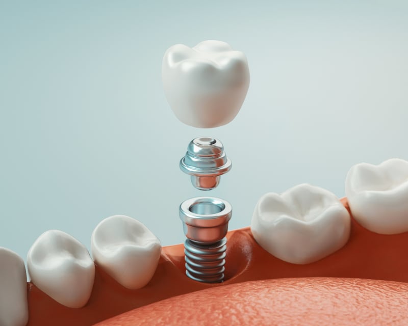 Dental Implants, Edmonton Dentist
